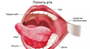 Рак слизистой оболочки полости рта